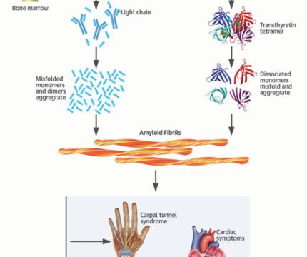 Causes of Amyloidosis