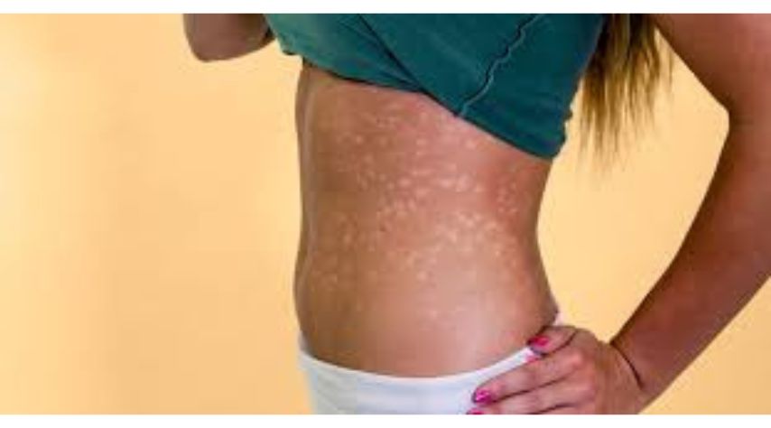 Guttate Psoriasis