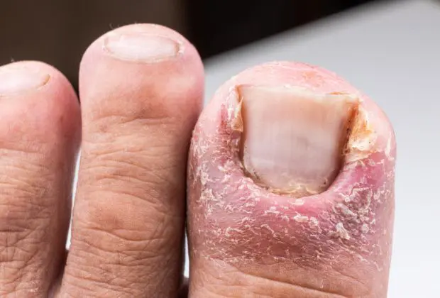 Nail Pitting - Causes, Symptoms, and Treatment