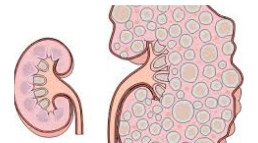 Initial Phase of Autosomal dominant Polycystic Kidney Disease