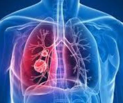 Unraveling the Complexities of Non-Small Cell Lung Cancer
