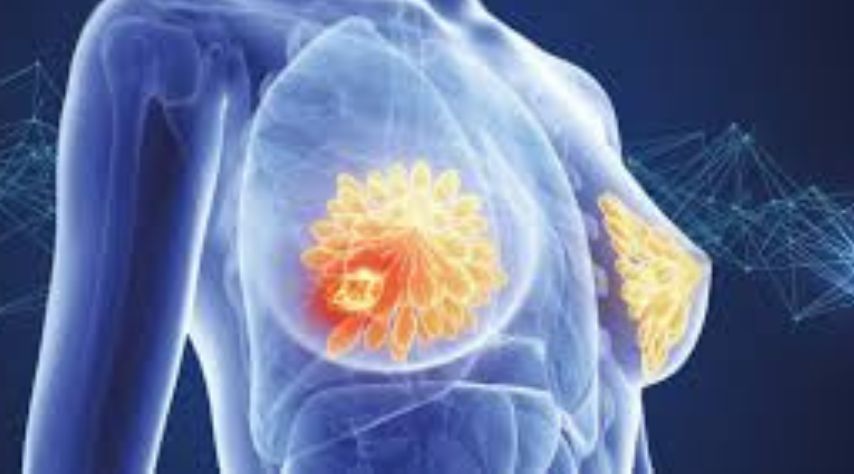 Breast Cancer Symptoms
