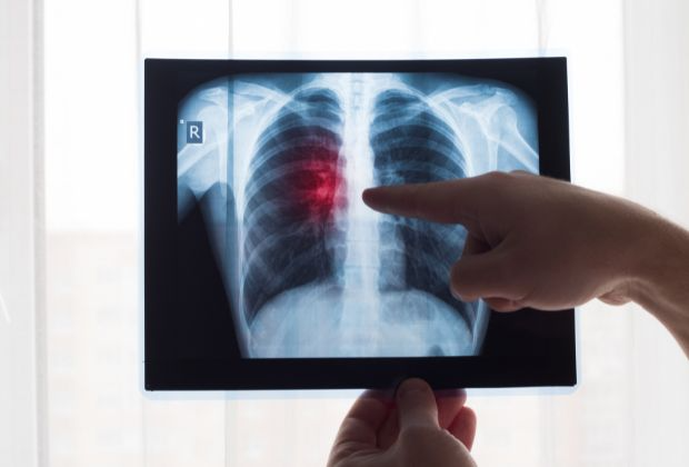 Lung Lesions In H3N2