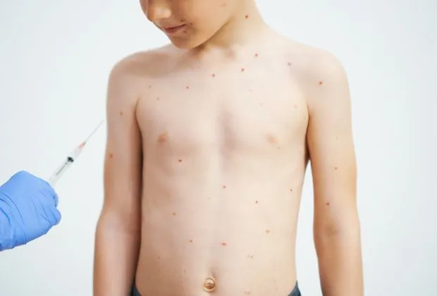Systemic Immunomodulatory Treatments for Atopic Dermatitis