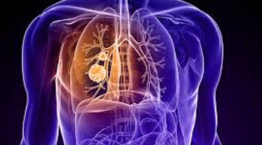 Impact of Non-small Cell Lung Cancer on Lung Function