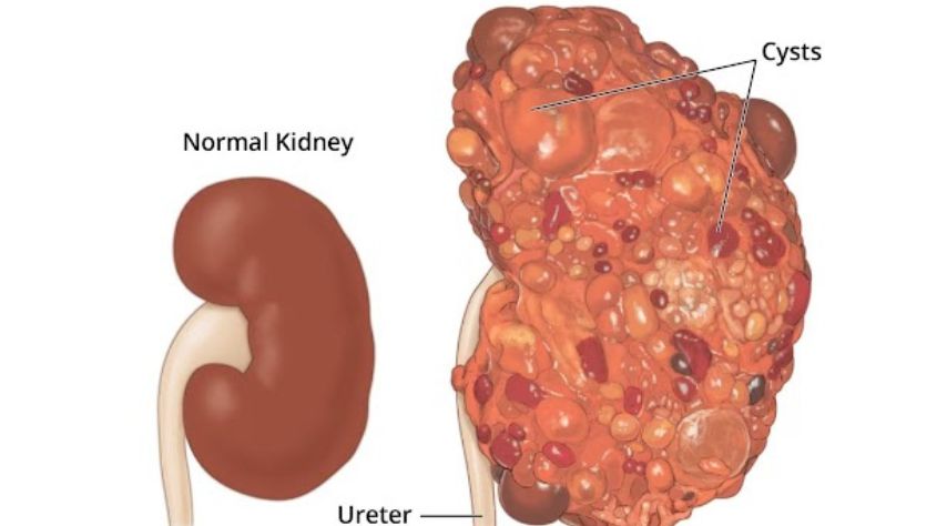 An Overview of Autosomal Dominant Polycystic Kidney Disease