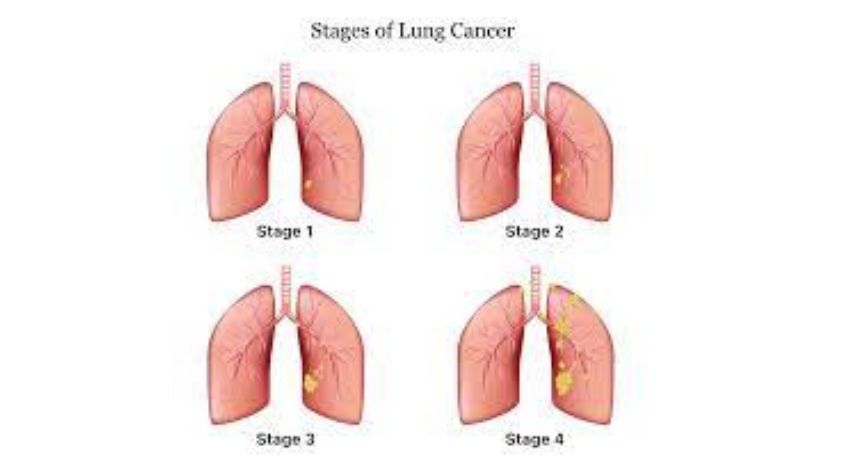 The stages of Non-small cell lung cancer