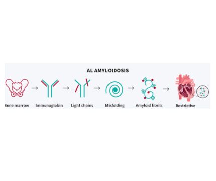 All about Secondary Amyloidosis