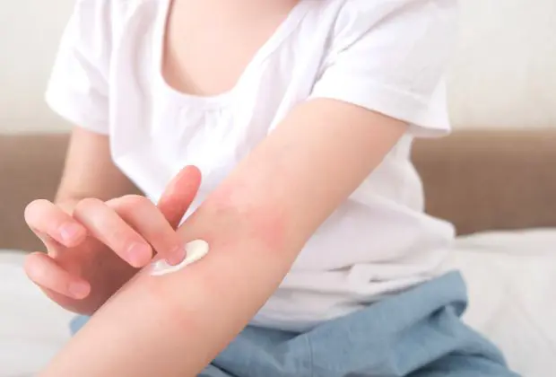 Tazarotene: An Overview