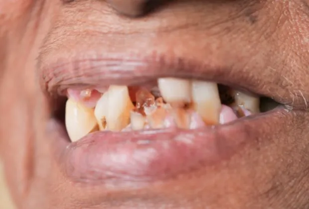 Gum Diseases and Rheumatoid Arthritis