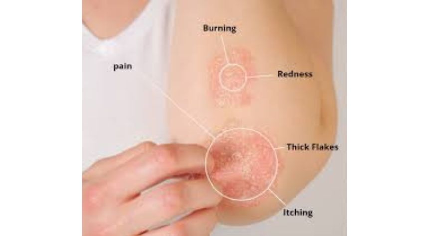 Symptoms of Psoriasis