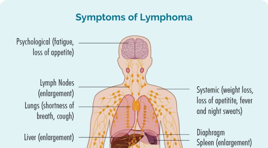 What Are the Symptoms of Lymphoma?