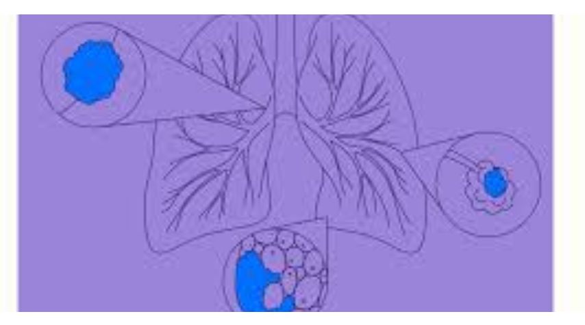 Scope of the treatment in non-small cell lung cancer