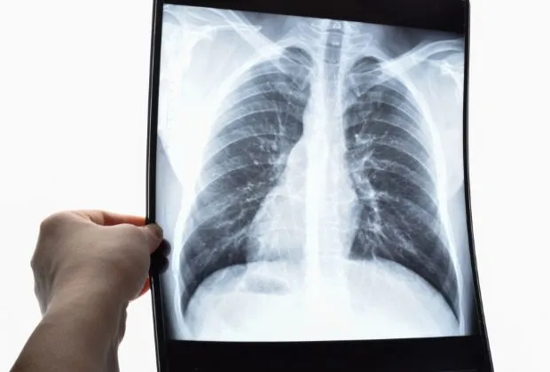 What Is Bronchioloalveolar Carcinoma?