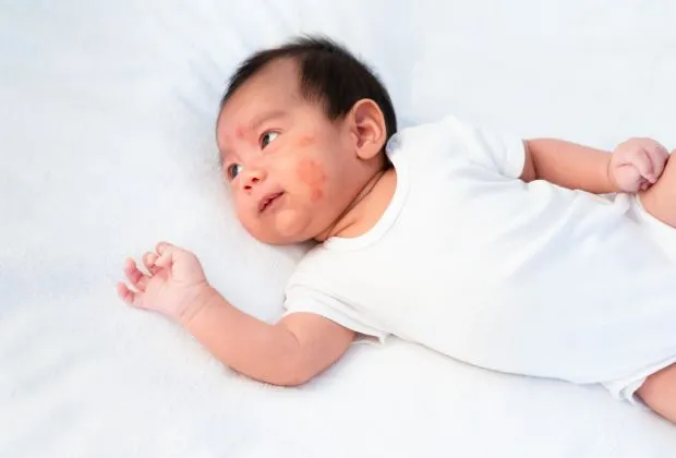 Infant Eczema: Causes, Symptoms, Treatment & Prevention
