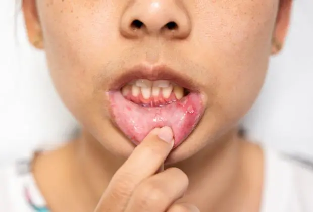 Oral Manifestations of Psoriasis: An Insight
