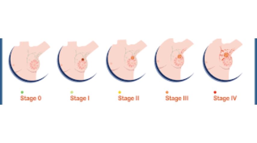 Stages of Breast Cancer