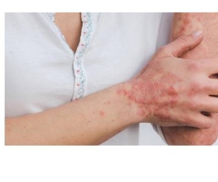 Beyond the Skin: Unveiling the Complexities of Psoriasis