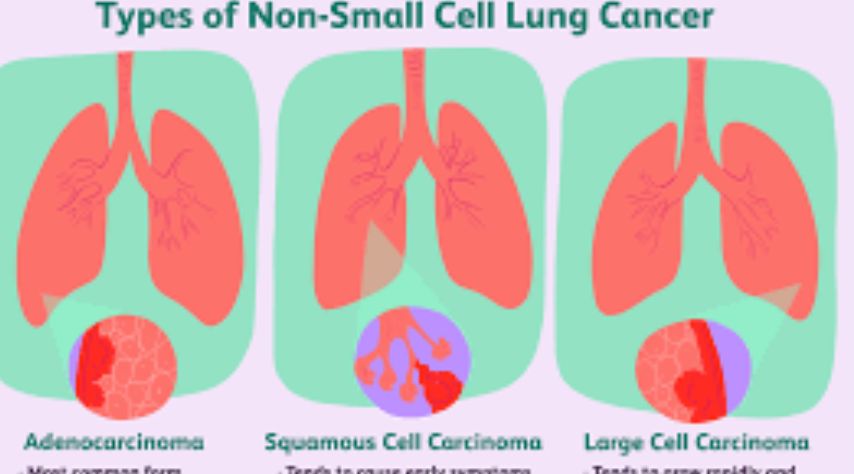 Various types of Non-small Cell Lung Cancer