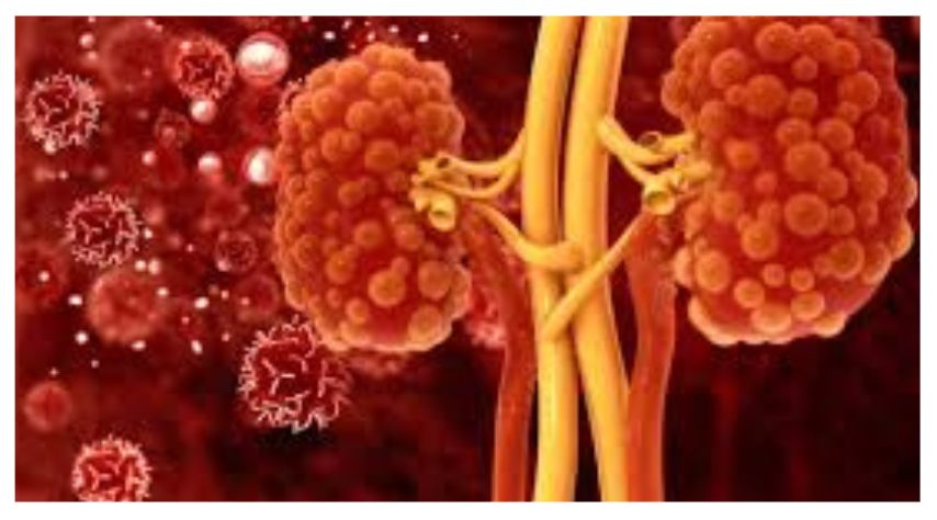 Clinical signs of Autosomal Dominant Polycystic Kidney Disease