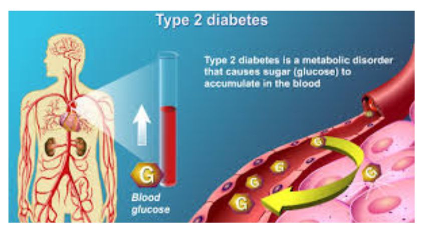 Long-term Complications of Type 2 Diabetes