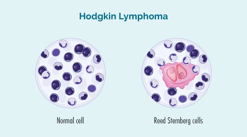 The Subtypes of Hodgkin’s Lymphoma