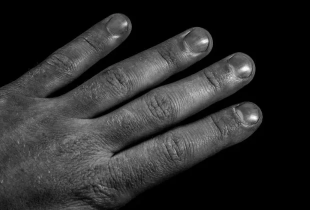 Cutaneous Tuberculosis in the Fingers