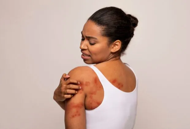 What Is Atopic Dermatitis? A Complete Beginner’s Guide