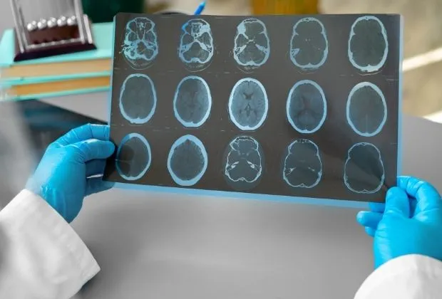 Tuberculomas - Causes, Symptoms, Diagnosis, and Management