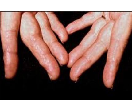 All about Primary Amyloidosis