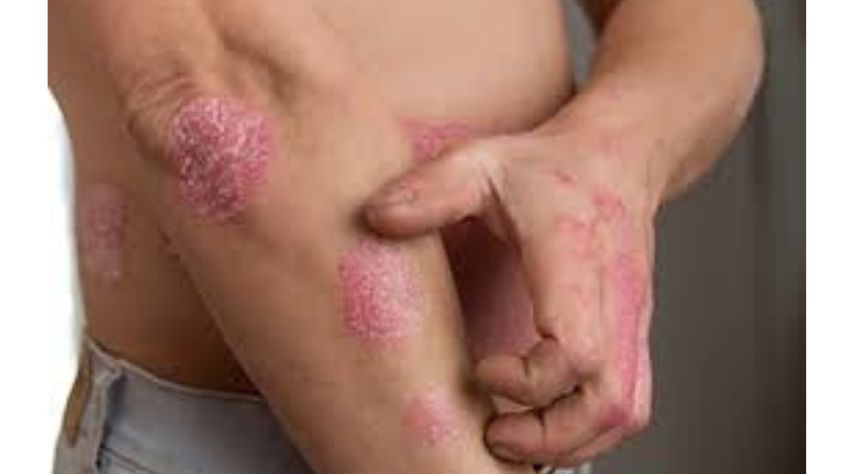 Plaque Psoriasis